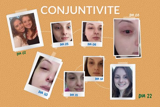Conjuntivite