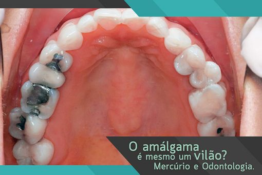 Mercúrio e Odontologia