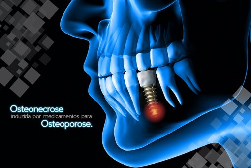 Necrose no maxilar associada ao uso de medicamentos contra osteoporose