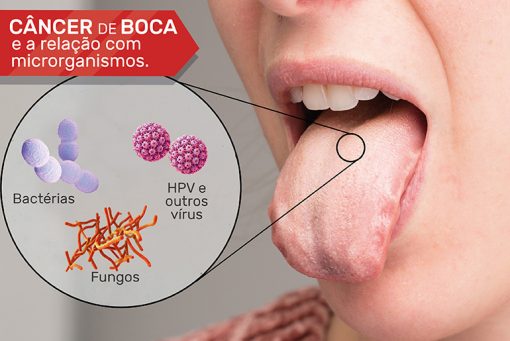 Câncer de Boca